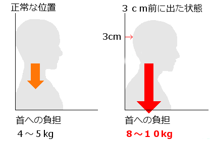 ストレートネックによる、首肩への負担