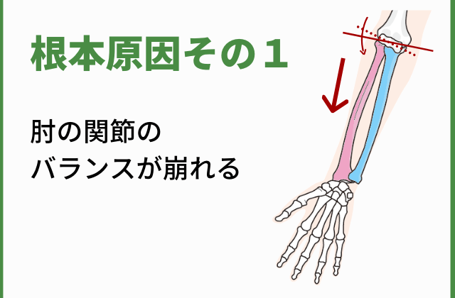 ズレた前腕のイラスト