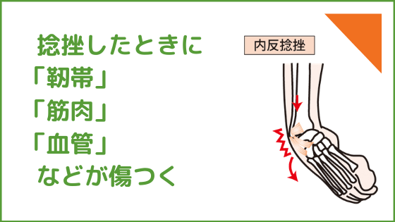 捻挫した状態とは。靭帯、筋肉、血管などが傷つく