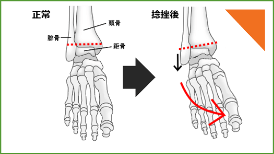 関節のバランスが崩れた足首の画像