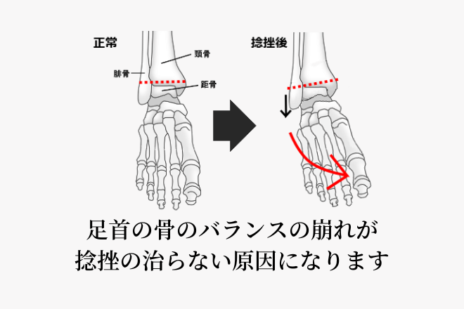 急な負荷だけでなく、繰り返す負荷によって関節のバランスが崩れることもあります