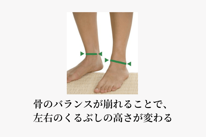 骨のバランスが崩れることで左右のくるぶしの高さが変わる