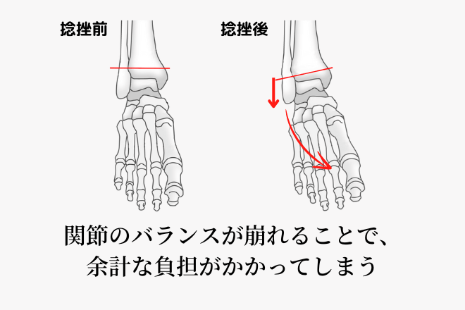 関節のバランスが崩れることで、余計な負担がかかってしまう