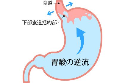 食道 食事 性 逆流 炎 「逆流性食道炎」は食事が大事！危険性をはらむ9つの食べ物&飲み物と改善方法