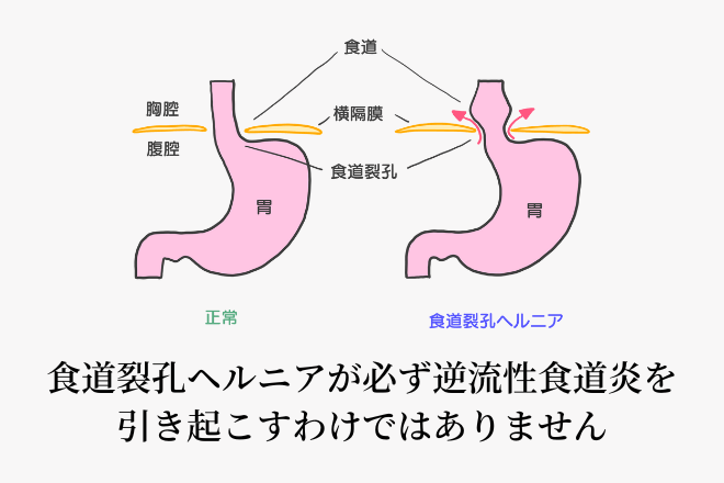 お尻の落ちた悪い姿勢に気をつけてください