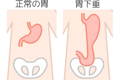 胃下垂のイメージ画像