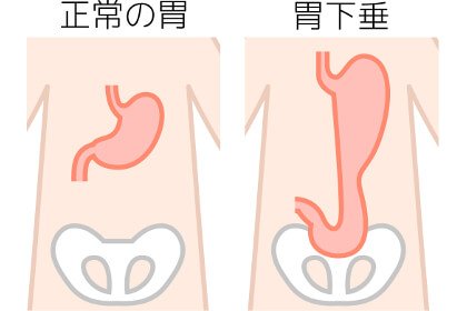 胃下垂の方のお腹の特徴とは 胃下垂かどうかの見極めポイント 大阪の整体 創輝鍼灸整骨院