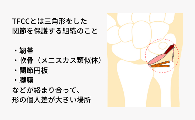 TFCC損傷について