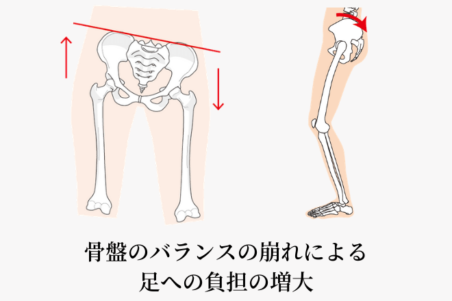 骨盤のバランスの崩れ方のイメージ図