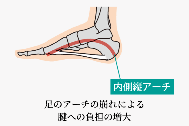 足のアーチの崩れによる腱への負担の増大のイラストイメージ