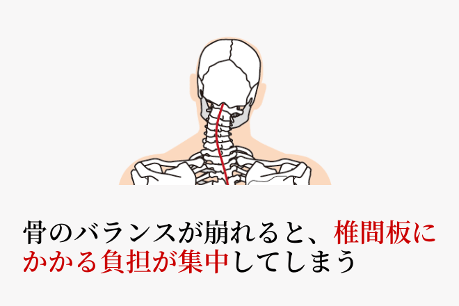骨のバランスが崩れると、椎間板にかかる負担が集中してしまう