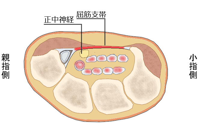 屈筋支帯の炎症
