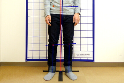 骨盤のバランスが崩れた姿勢の検査の写真
