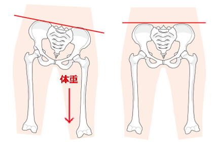 骨盤のバランスが崩れることによって、片側の足に体重がかかる