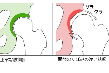骨盤のバランスの崩れ