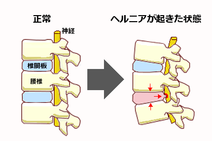 手術と保存療法（手術しない）ケースの比較について