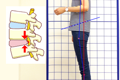 腰痛の姿勢分析をしている写真