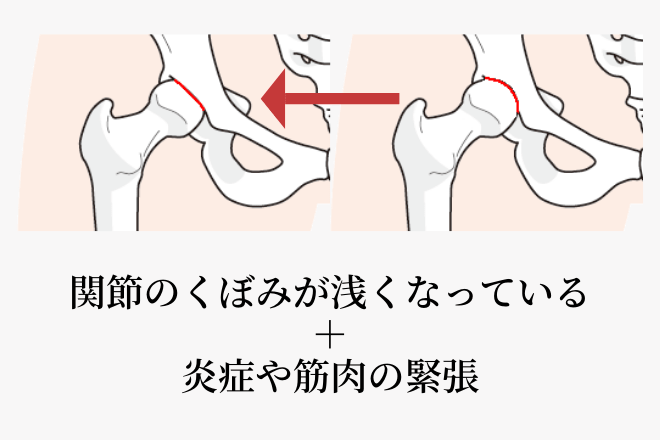 一般的に言われている股関節の痛みの原因・臼蓋形成不全を表したイラスト
