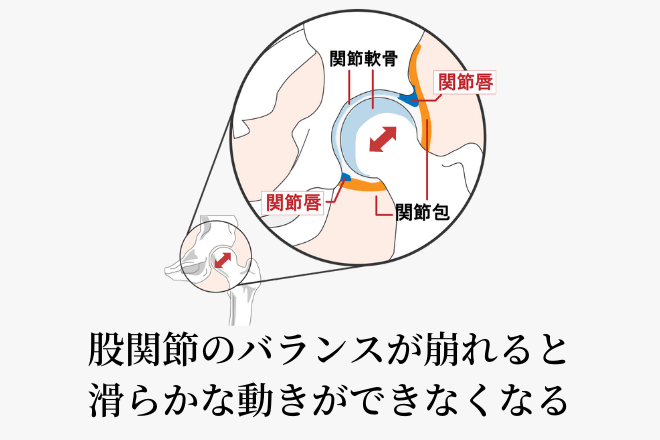 股関節のバランスの崩れた状態を表すイラスト