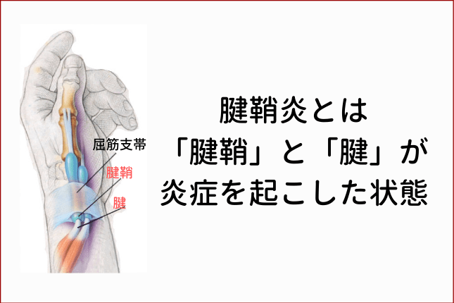 腱鞘炎とは「腱鞘」と「腱」が炎症を起こした状態