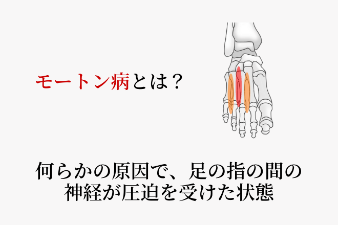 モートン病とは