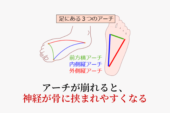 足のアーチとモートン病