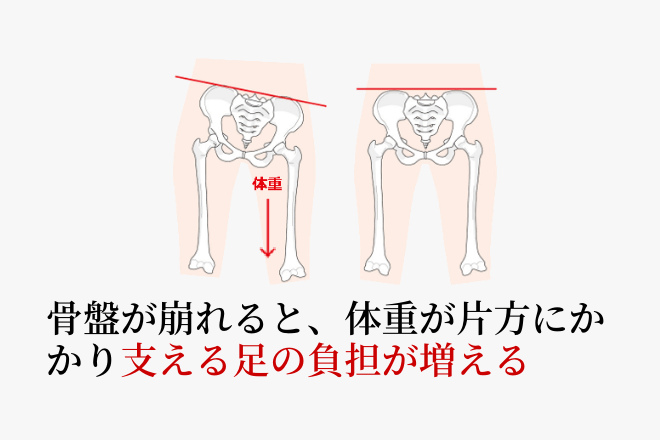 骨盤のバランスの崩れ