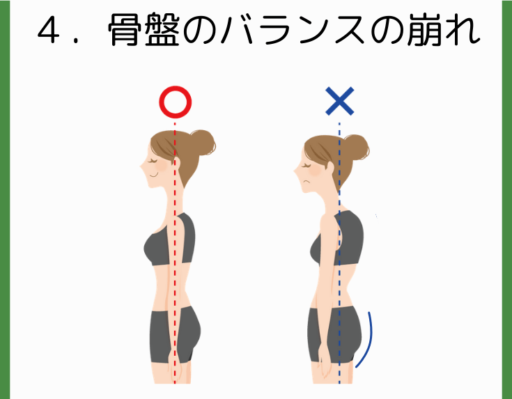 お尻が落ちた骨盤のバランスの崩れ