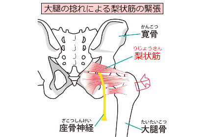 梨状筋と坐骨神経のイラスト
