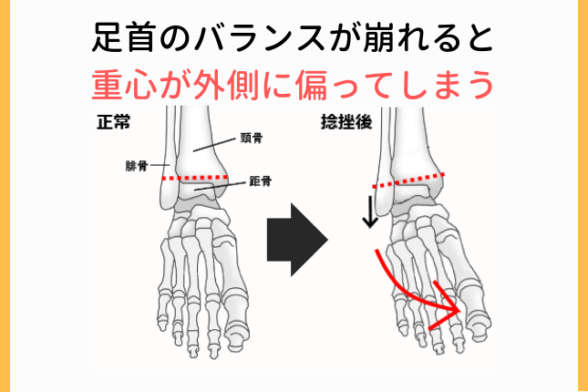 足首のバランスの崩れ