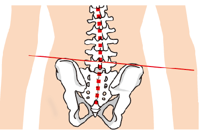 脊柱管狭窄症の原因１．骨盤のバランスの崩れ
