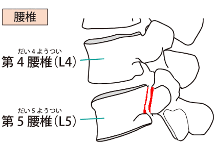 腰椎分離症の骨の状態