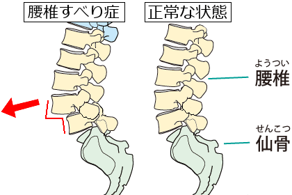 腰椎すべり症のイラスト 第４腰椎が前方へと移動