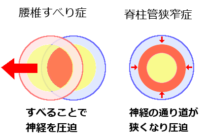 腰椎すべり症と狭窄症の違いのイラスト