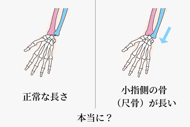 正常な前腕と尺骨突き上げ症候群の違いのイラスト