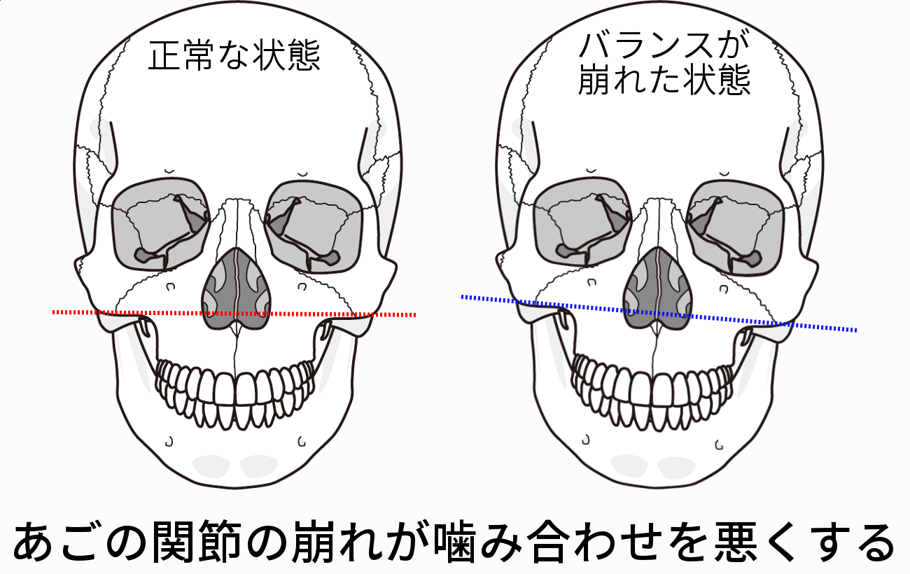 あごの関節のバランスの崩れの比較図