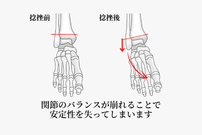 関節のバランスが崩れることで関節や靭帯に強い負担がかかります