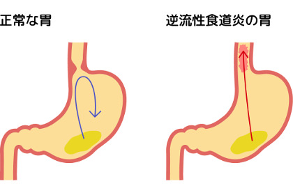 胃酸が逆流する仕組み