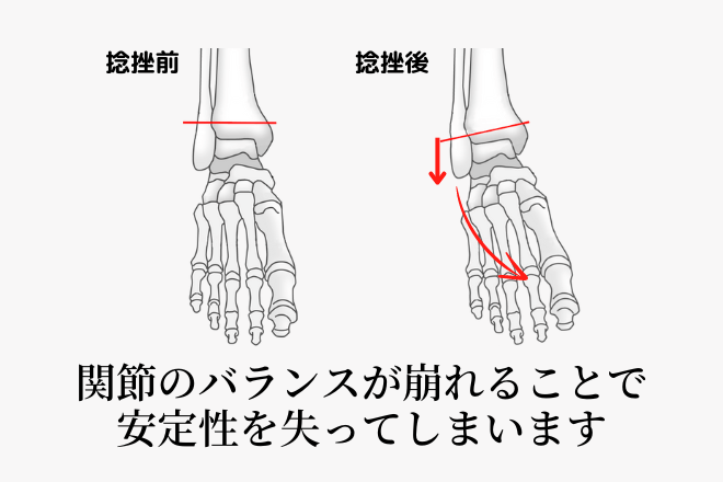 関節のバランスが崩れることで安定性を失ってしまいます