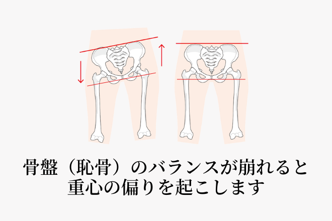 足首の捻挫による、関節の高さのズレ