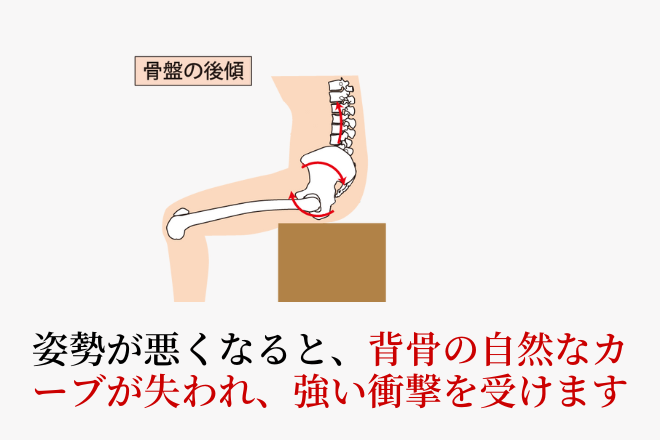 腰椎分離症の姿勢の問題