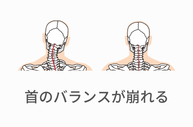 首の関節のバランスの崩れ