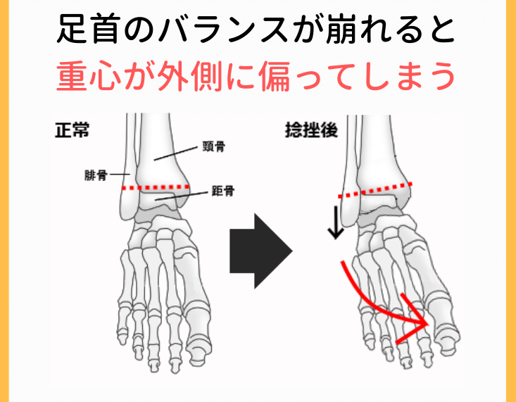 足首のバランスの崩れ
